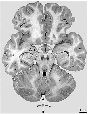 The Subcortical-Allocortical- Neocortical continuum for the Emergence and Morphological Heterogeneity of Pyramidal Neurons in the Human Brain